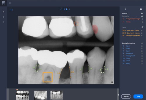 Figure: Overjet’s Clinical Intelligence Platform displays a radiograph with dental artificial intelligence findings.