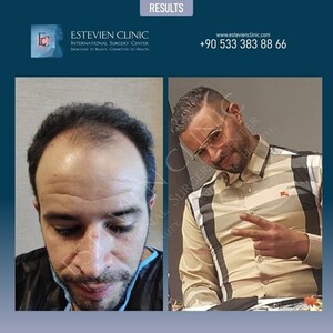 Estevien Clinic: High-Quality Hair Transplant in Turkey