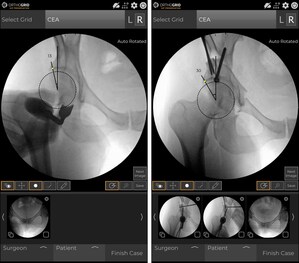 OrthoGrid Systems, Inc. Announces Launch of New OrthoGrid Hip Preservation Software Application for Peri Acetabular Osteotomy and Femoroplasty