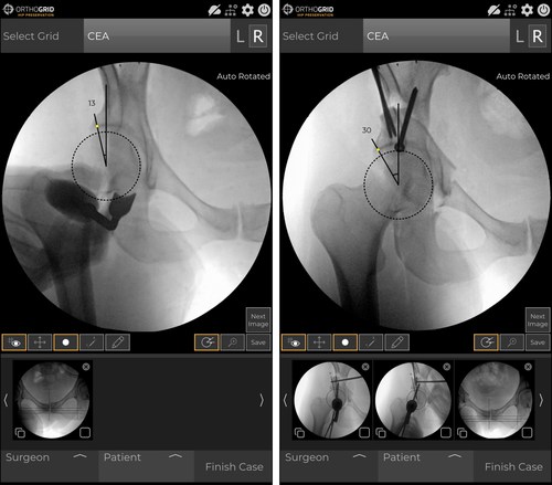 Pre & Post-osteotomy Center-Edge Angle measurements in a Periacetabular Osteotomy (PAO) procedure