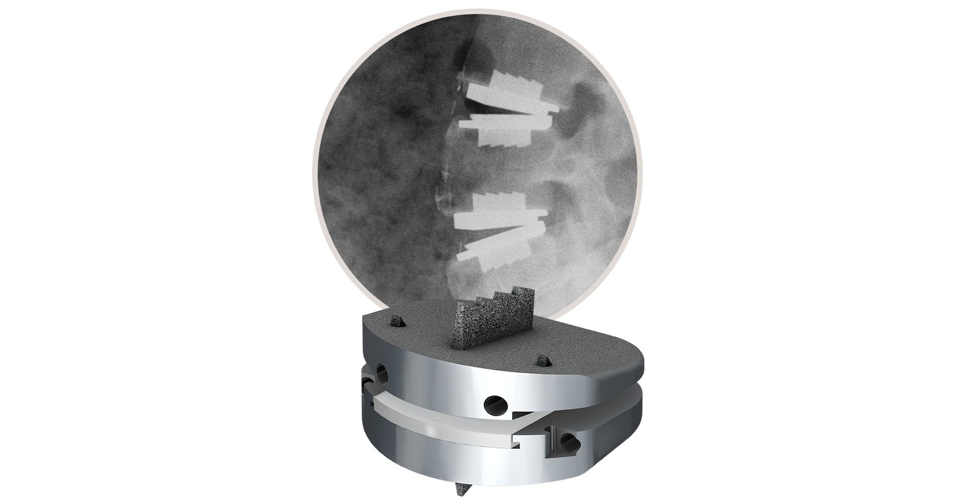 New Study Demonstrates Longterm Effectiveness of Centinel Spine's prodisc® L Total Disc Replacement