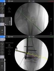 OrthoGrid Systems, Inc. Announces Launch of New OrthoGrid Trauma...