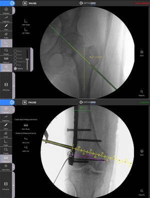 OrthoGrid Systems, Inc. Announces Launch of New OrthoGrid Trauma Software Application for Open Reduction and Internal Fixation (ORIF) procedures.