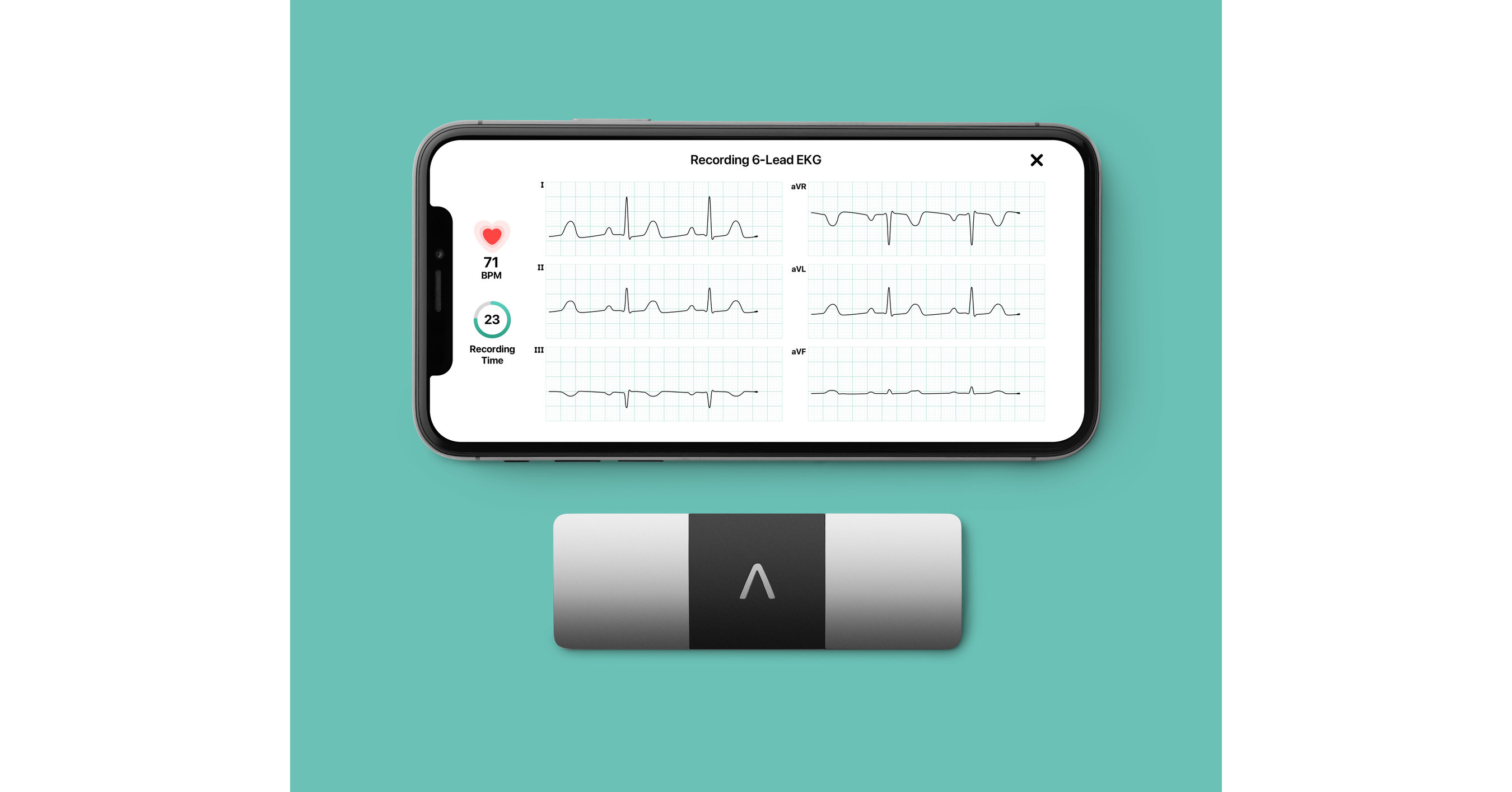 AliveCor Kardia Mobile single-lead handheld ECG (Image used with