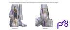 Paragon 28, Inc. Increases its Robust Hindfoot Fusion Plating Offering, Launching the Silverback™ Span Plating System