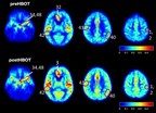 Emerging Peer-Reviewed Study Shows Reversal in Biological Hallmarks Responsible for Development of Alzheimer's Disease