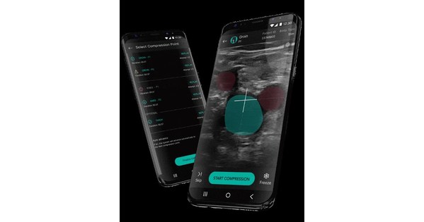 Resultados do software de detec&ccedil;&atilde;o de trombose venosa profunda ThinkSono s&atilde;o publicados na Nature Digital Medicine (npj)