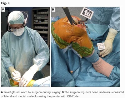 A: Vuzix Smart Glasses worn by the surgeon during surgery. B: The surgeon registers bone landmarks 
consisting of lateral and medial malleolus using the pointer with QR-Codes.