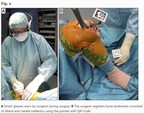 Clinical Pilot Study Confirms the Accuracy and Effectiveness of Pixee Medical's Knee+ Solution Using Vuzix M400 Smart Glasses for Total Knee Arthroplasty