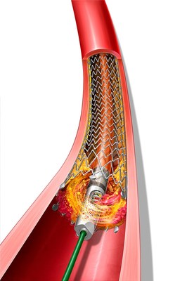 The Rotarex™ Atherectomy System is a rotational excisional device that is built to remove and aspirate varying lesion morphologies including plaque and thrombus in the peripheral arteries. The Rotarex™ System, already cleared for use in native arterial vessels, now has the expanded indications to treat within peripheral arteries fitted with stents, stent grafts, and native or artificial bypasses.