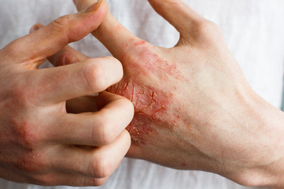 Un cas de dermatite atopique modérée à sévère montré sur le patient. (Groupe CNW/Allergan, an AbbVie Company)