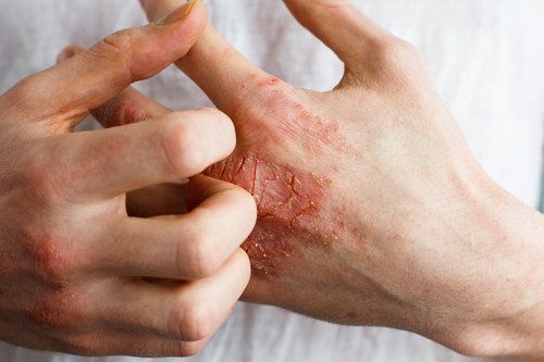 A case of moderate to severe atopic dermatitis shown on patient. (CNW Group/AbbVie Canada)