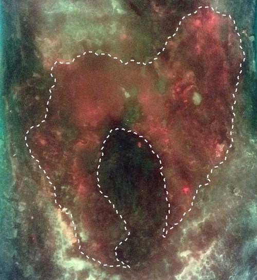 An example of wound-related cellulitis from the study is shown. When imaged with the MolecuLight i:X, an irregular pattern of red (bacterial) fluorescence extending beyond the wound bed and periwound is visible. This pattern of red fluorescence, demonstrating invasive extension of bacteria into surrounding tissues, was consistent in all wounds in the study where wound-related cellulitis was diagnosed. (CNW Group/MolecuLight)