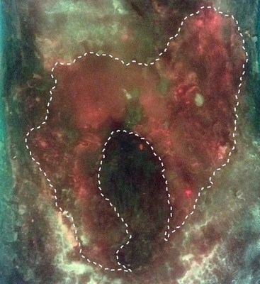 An example of wound-related cellulitis from the study is shown. When imaged with the MolecuLight i:X, an irregular pattern of red (bacterial) fluorescence extending beyond the wound bed and periwound is visible. This pattern of red fluorescence, demonstrating invasive extension of bacteria into surrounding tissues, was consistent in all wounds in the study where wound-related cellulitis was diagnosed.