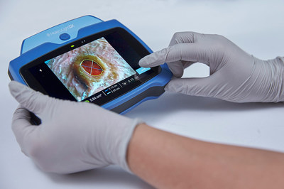New Stickerless digital wound area measurement for documentation and monitoring of wound progression