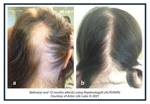 New Study Shows Replenology® Hair System from Arbor Life Labs Prevents Female Hair Loss and Promotes Growth