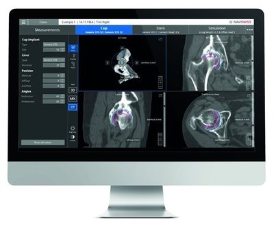 Naviswiss, a Swiss-based medical technology company receives clearance from the FDA to market Naviplan in the United States. Naviplan is a digital pre-operative planning application enabling orthopedic sugeons to perform navigated CT-based total hip replacement surgery. This has the potential to improve accuracy, predictability and provide seamless documentation of the outcome.