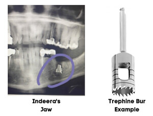 Texas Woman Sues Oral Surgeon After Metal Drill Bit Left Inside Her Jaw
