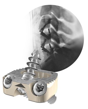 New Publication Supports Clinical Effectiveness of Centinel Spine's STALIF® Integrated Interbody™ System