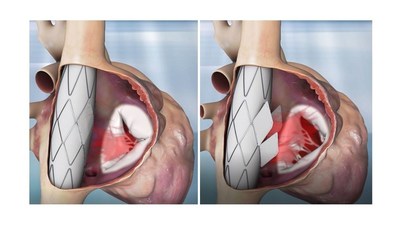 The Trillium™ implant. In systole (left) and diastole (right). (PRNewsfoto/Innoventric)