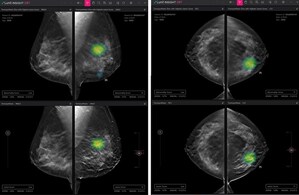 Lunit to Participate in RSNA 2021, Presenting its New AI Solutions for Digital Breast Tomosynthesis and Chest CT