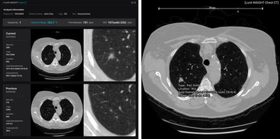 Lunit INSIGHT Chest CT Demo