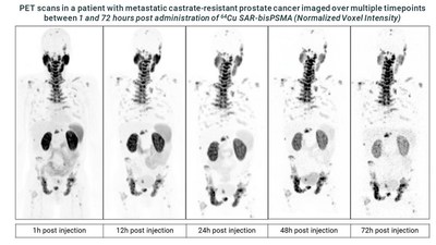 PET scans in a patient with metastatic castrate-resistant prostate cancer imaged over multiple timepoints between 1 and 72 hours post administration of Cu-64 SAR-bisPSMA (Normalized Voxel Intensity)