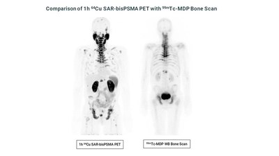 Comparison of 1h Cu-64 SAR-bisPSMA PET with Tc-99m MDP Bone Scan