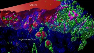 A 3D reconstruction of a mouse prostate 50 days after the start of cancer. The red mass represents the growing tumor, the green and purple represent prostate cells, and the blue represents DNA. Using a new method developed at CSHL, researchers can track the progression of prostate cancer from birth to its spread into other organs. In the image, the small red balls detached from the red mass are cancer cells that are beginning to migrate. Image: Julian Taranda/Osten lab/CSHL, 2021