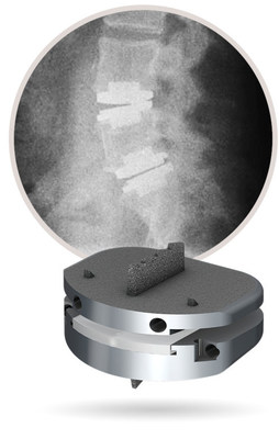 prodisc L Device Shown with 2-Level Lateral Fluoroscopy.