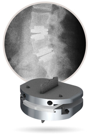 New CPT Add-on Code Accepted for Second Level of Lumbar Total Disc Replacement Procedures