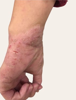 An example of atopic dermatitis (AD)