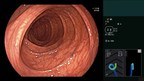 Fujifilm launches ColoAssist PRO, a real-time endoscope visualisation system which aims to help endoscopists perform efficient, accurate and comfortable colonoscopies