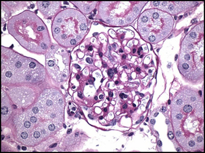 The larger, centrally located structure shown here is a glomerulus in a mouse kidney, which is known to be damaged by diabetes, as made evident by the scar tissue dyed purple in the image. The study authors show that administration of RAGE229 to diabetic mice reduced damage to the glomeruli and surrounding structures in the kidney. Reprinted with permission from Schmidt et al., Sci. Transl. Med. 13, eabf7084 (2021).