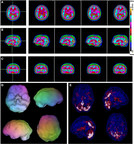 Study From Amen Clinics Identifies Reliable Biomarkers for ADHD