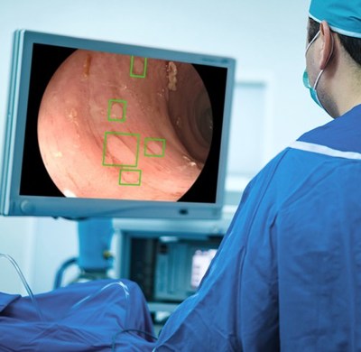 GI Genius™ intelligent endoscopy module works in real-time, automatically identifying and marking abnormalities consistent with colorectal polyps, including small flat polyps (CNW Group/Medtronic Canada ULC)