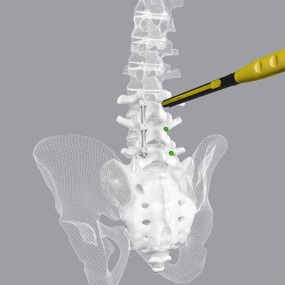 The CoreLink CentraFix Midline Fixation System provides a low implant profile and allows screw placement through a midline cortical trajectory. The system offers strength without compromise with modular tulip heads and screw shanks designed specifically for cortical fixation.