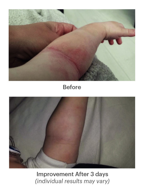 New treatment option for eczema patients: Clinical study proves safe anti-S. aureus endolysin 'Staphefekt SA.100' significantly reduces eczema symptoms - Vimarsana News