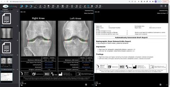 Knee X-Ray with Radiobotics AI generated report.