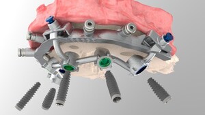 Issuance of U.S. Patent Covering Guides for Dental Full Arch Surgery and Immediate Restoration.