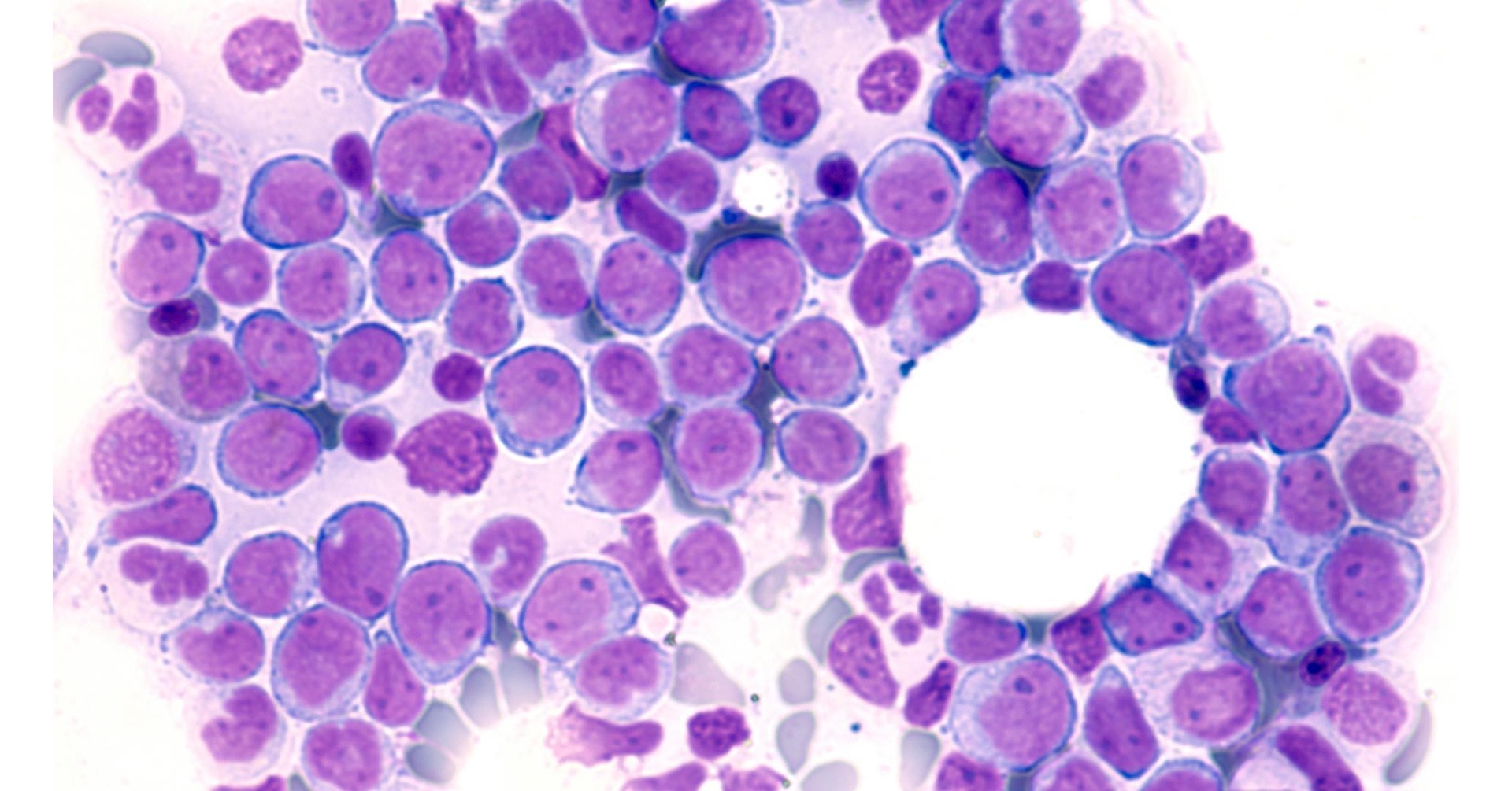 Exploiting cancer's sweet tooth