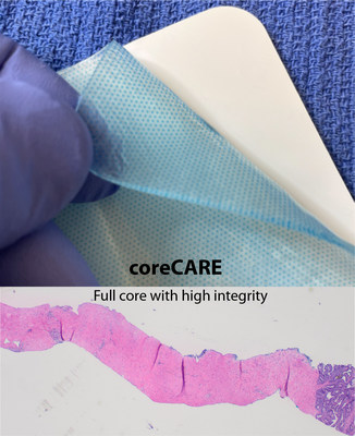 URO-1 coreCARE&trade; Specimen Retrieval Kit; full core biopsy specimen with high tissue integrity