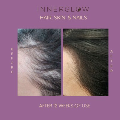 Hair growth post COVID infection with Inner Glow Advanced Hair, Skin & Nails Formula