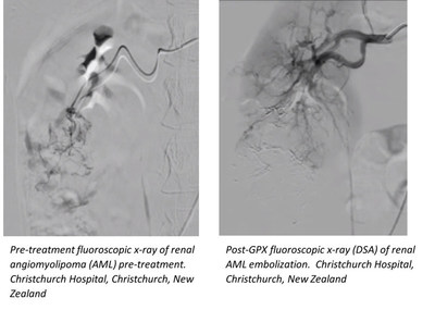 Renal AML Embolization Using GPX Embolic Device - Christchurch Hospital, Christchurch, New Zealand