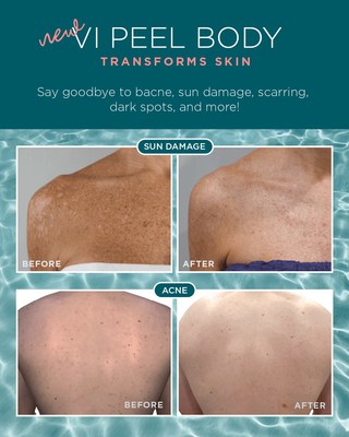 Formulated exclusively for the skin on your body, NEW VI Peel Body Treatments lift pigment and sun damage, fight active acne and acne scarring, as well as soften wrinkles, stretch marks, and more!