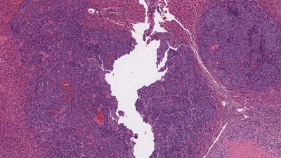 A cross-section of mouse liver tissue containing a liver cancer tumor. Cancer tissue is shown in purple and healthy tissue is shown in pink. CSHL Professor Adrian Krainer and his team found a way to make mouse liver cells produce a cancer-suppressing protein and simultaneously reduce the levels of a cancer-promoting protein, using RNA-based molecules called antisense oligonucleotides (ASOs). Image: Dillon Voss/Krainer lab/CSHL, 2021