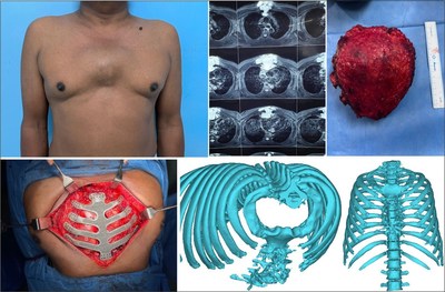 Entire sternum ribs reconstruction using a 3D printed custom-made titanium implant