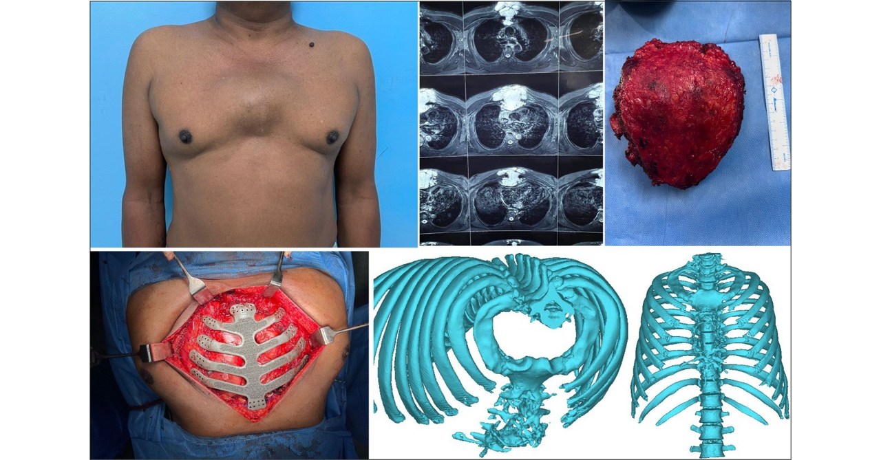 3-D Printer Uses Metal To Make Custom Rib Cage For Cancer Patient : Shots -  Health News : NPR