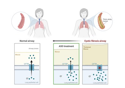 Cystic fibrosis is caused by mutations in the cystic fibrosis transmembrane regulator (CFTR) gene that disrupt normal CFTR expression and function as a membrane chloride channel, leading to thick mucus buildup in the airways of the lungs. Antisense oligonucleotide (ASO) treatment modifies CFTR gene expression leading to increased expression of a modified protein with retained channel function (CFTR*). Credit: Created with BioRender.com