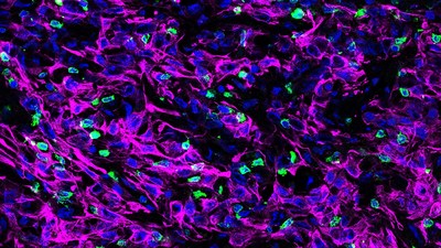 A cross-section of mouse pancreatic tumor tissue. These cancer cells (stained purple) lack a protein called KRT19 on their outer layer that is part of a complex that deactivates T cell (green) movement. Without KRT19, T cells are able to infiltrate the tumor. Cell nuclei are labeled in blue. Image: ZhiKai Wang/Fearon lab/CSHL, 2022